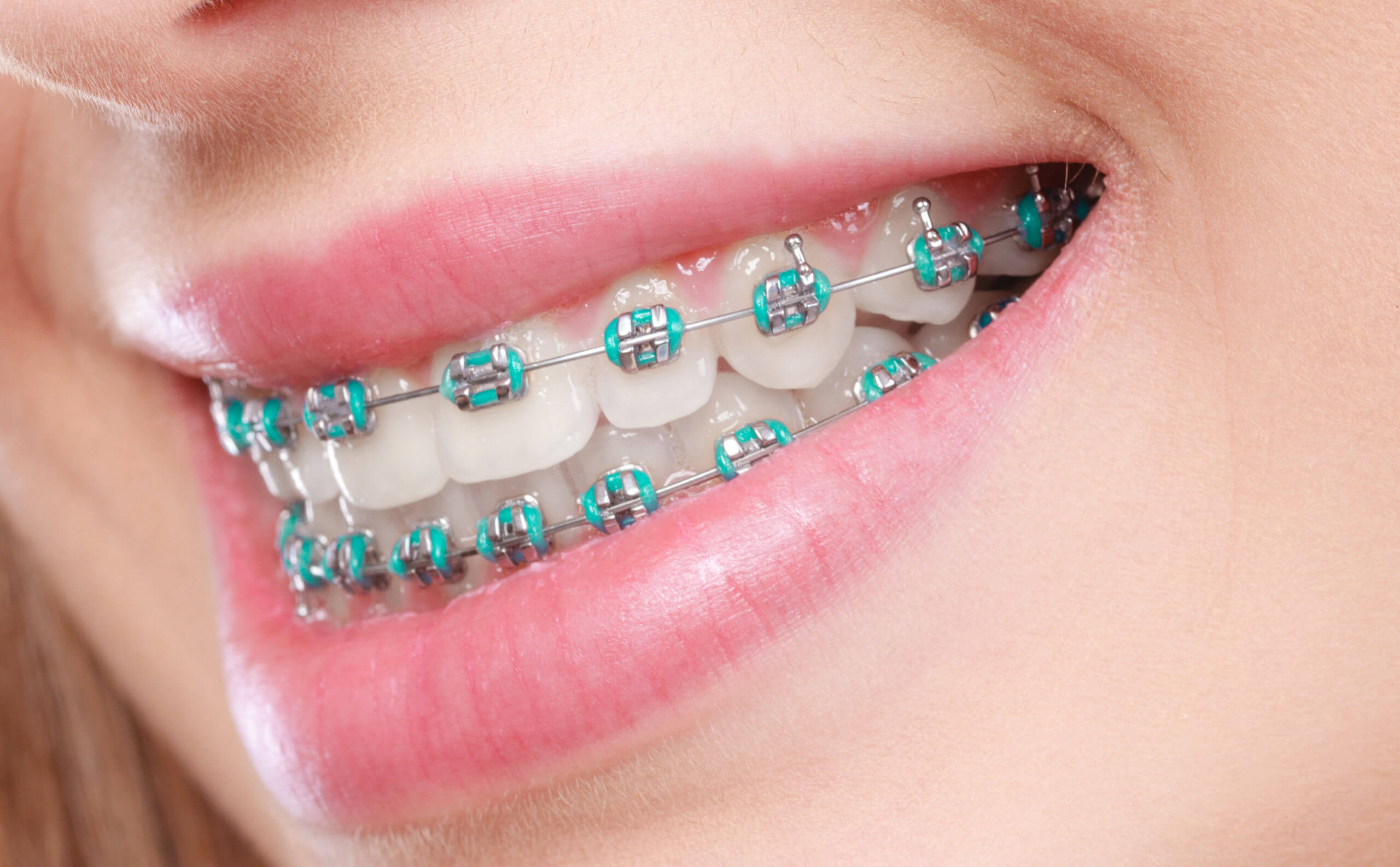 Orthodontics / Braces